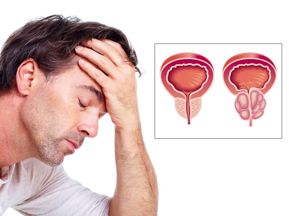 Adenoma prostatico con impotenza
